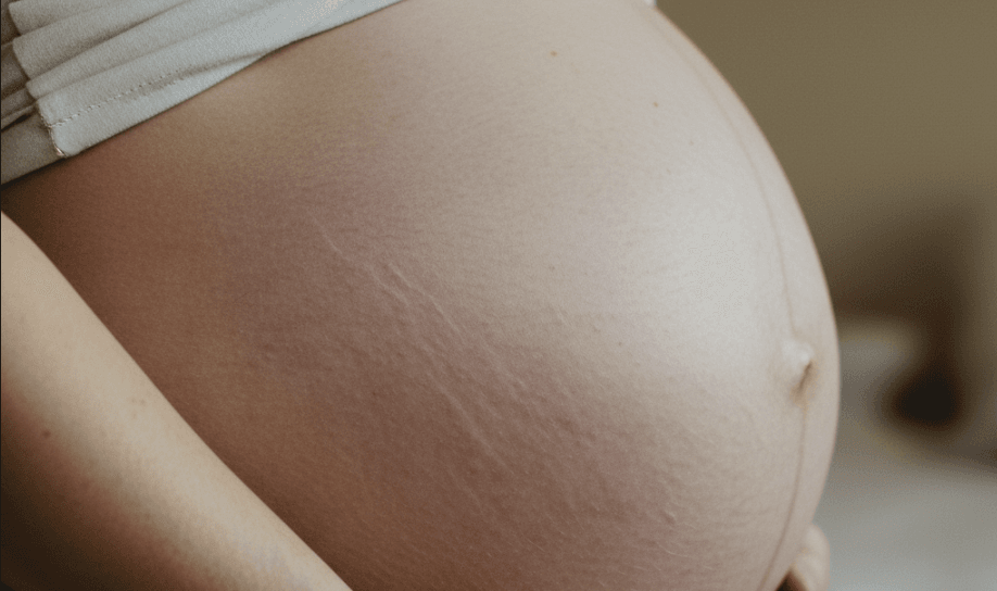 妊娠線を説明するためのイメージ画像